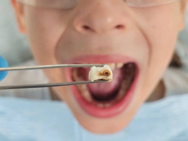 Best Emergency Wisdom Teeth Removal in Sterling, VA